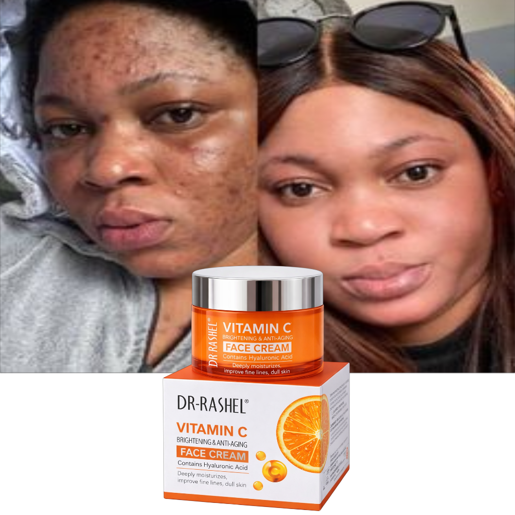 Creme removedor de manchas - Vitamina C