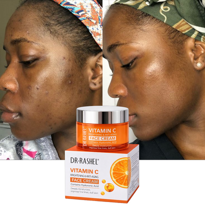 Creme removedor de manchas - Vitamina C