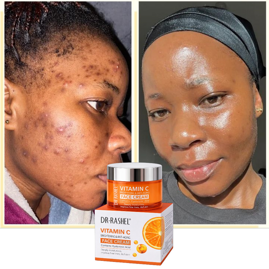 Creme de Vitamina C - Remove Manchas, Acne e Rugas
