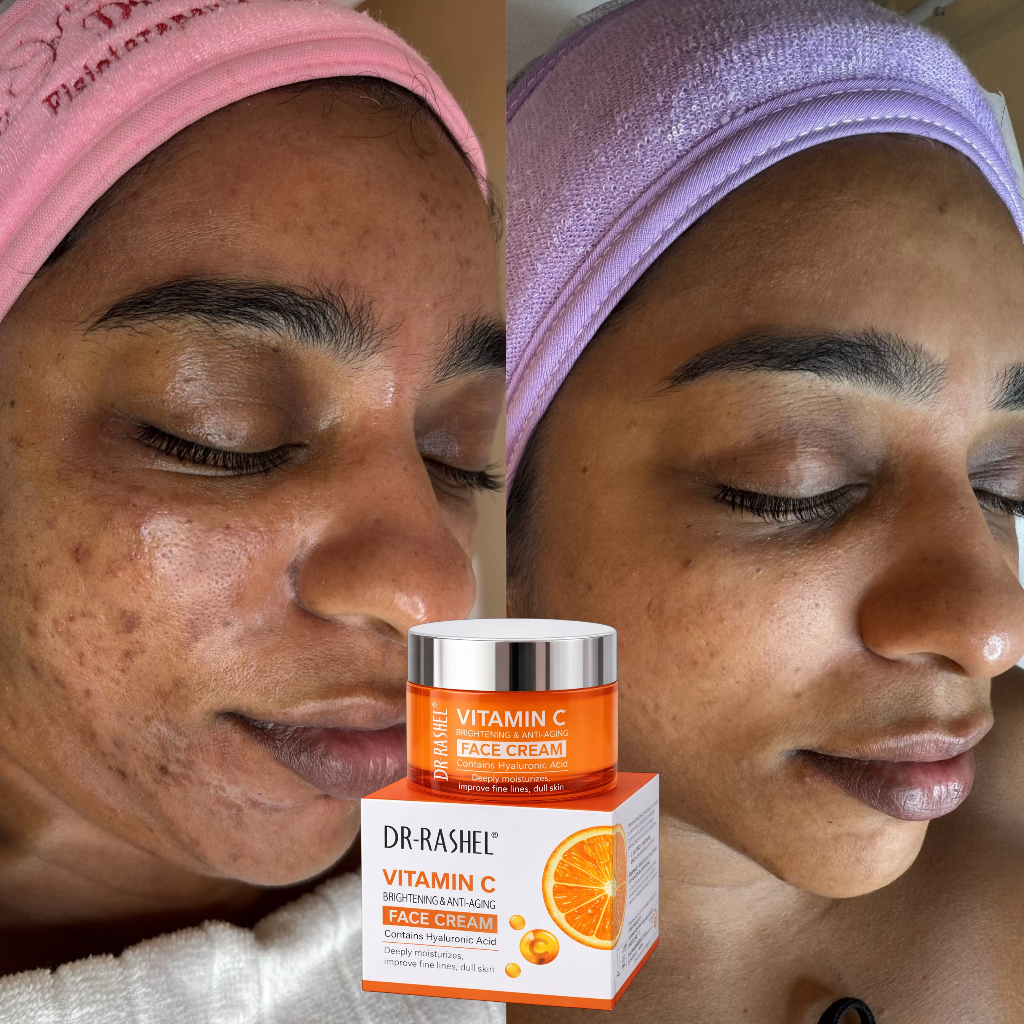 Creme removedor de manchas - Vitamina C
